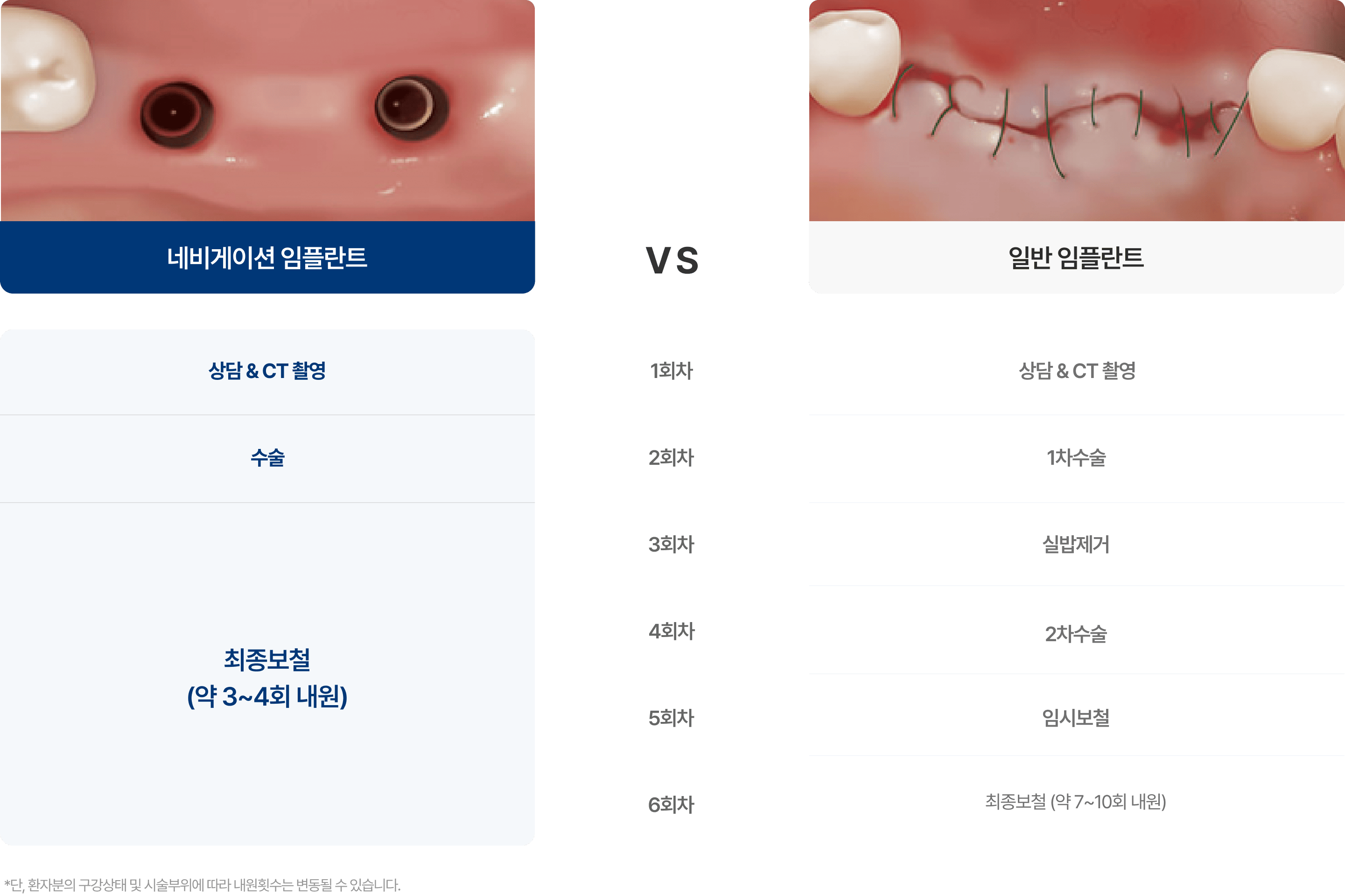 네비게이션 임플란트와 일반 임플란트의 차이