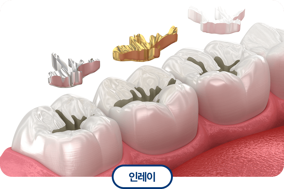 인레이