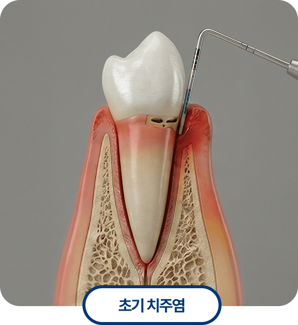 초기 치주염