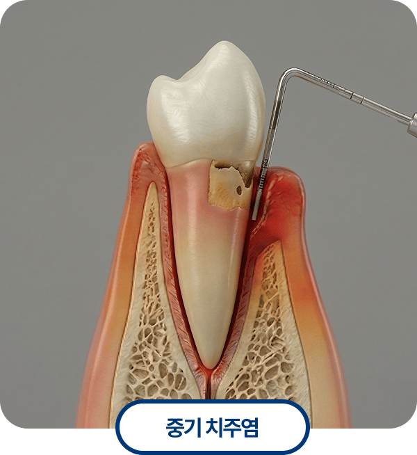 중기 치주염