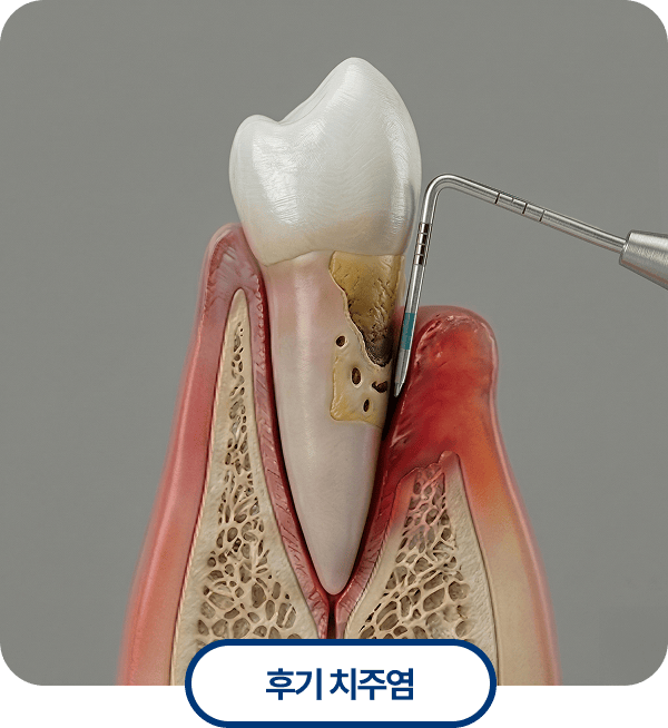 후기 치주염